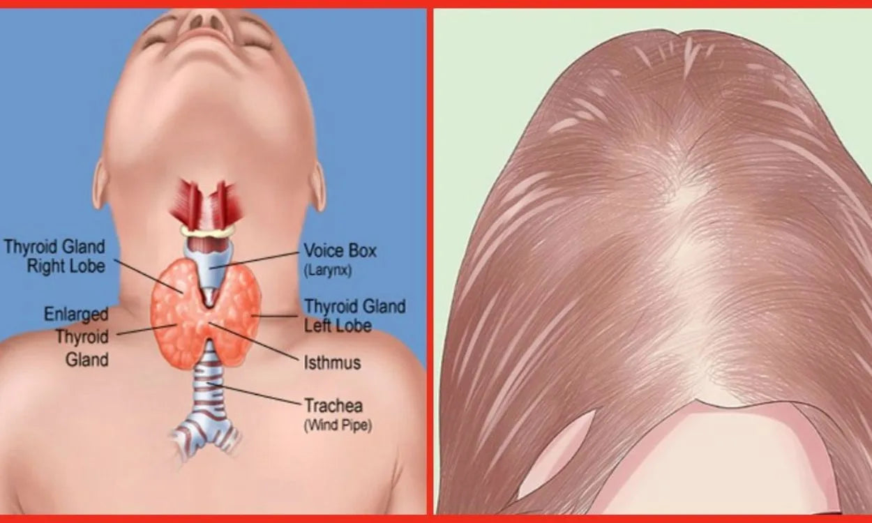 Thyroid-Related Hair Loss